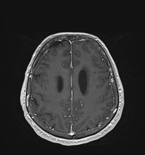 Neurofibromatosis type 2 (Radiopaedia 79097-92049 Axial T1 C+ 143).jpg