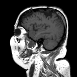 File:Neurofibromatosis type 2 (Radiopaedia 8713-9518 Sagittal T1 5).jpg