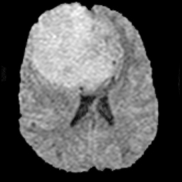 File:Neurofibromatosis type 2 (Radiopaedia 8953-9730 Axial DWI 1).jpg