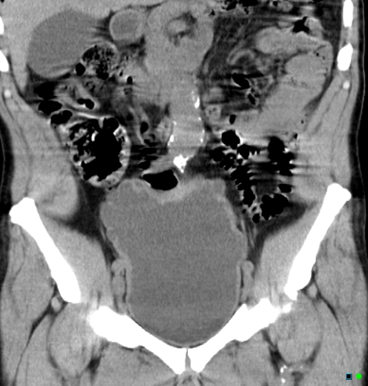 File:Neurogenic bladder - CT findings (Christmas tree bladder) (Radiopaedia 26995-27174 Coronal non-contrast 5).jpg