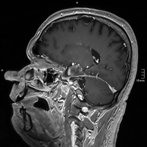 Neurosarcoidosis - involvement of the mesial temporal lobes (Radiopaedia 67429-76820 Sagittal T1 C+ 67).jpg