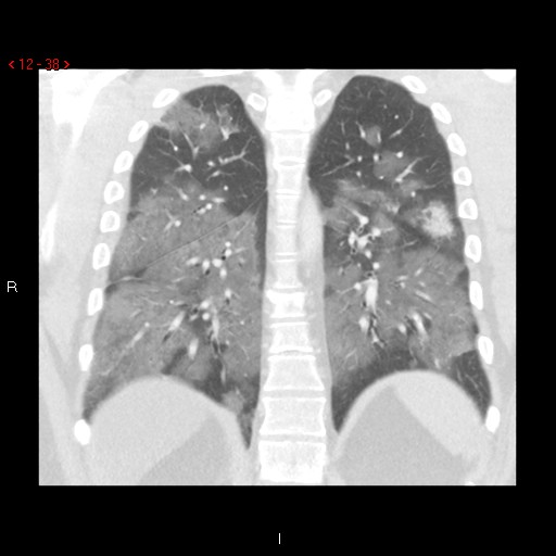 File:Non-specific interstitial pneumonitis (Radiopaedia 27044-27222 Coronal lung window 38).jpg
