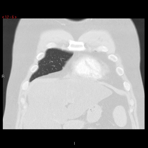 File:Non-specific interstitial pneumonitis (Radiopaedia 27044-27222 Coronal lung window 6).jpg