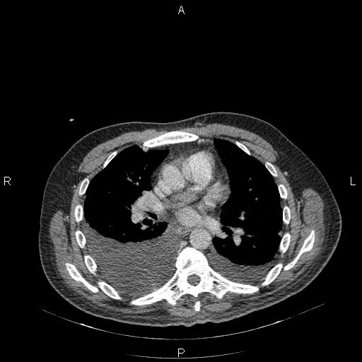 File:Non Hodgkin lymphoma in a patient with ankylosing spondylitis (Radiopaedia 84323-99624 B 15).jpg