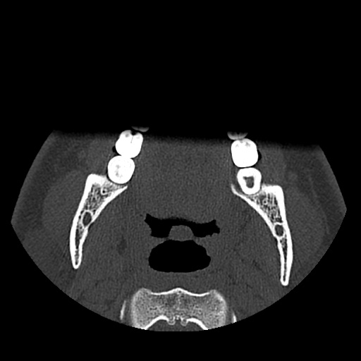 Normal CT paranasal sinuses (Radiopaedia 42286-45390 Axial bone window 118).jpg