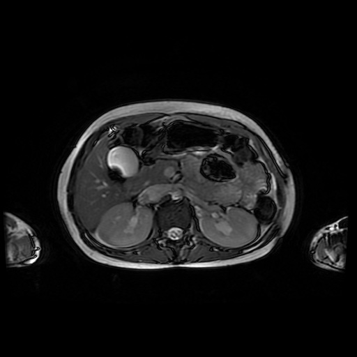 File:Normal MRI abdomen in pregnancy (Radiopaedia 88001-104541 Axial Gradient Echo 17).jpg