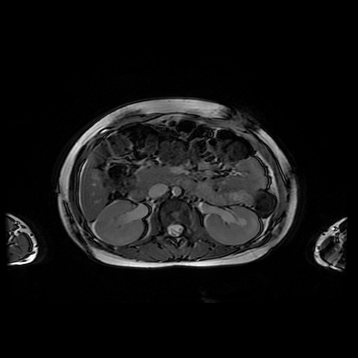 File:Normal MRI abdomen in pregnancy (Radiopaedia 88001-104541 Axial Gradient Echo 20).jpg