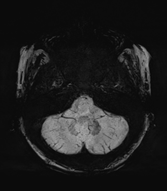 Normal MRI internal auditory canal (Radiopaedia 41613-44525 Axial SWI MIP 15).png