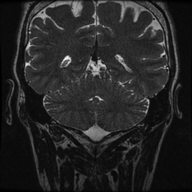 Normal MRI petrous (Radiopaedia 91317-108949 Coronal T2 98).jpg