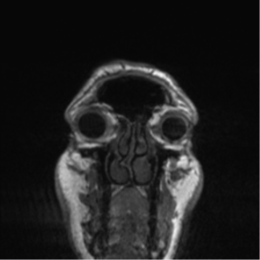Normal brain MRI (non-focal epilepsy protocol) (Radiopaedia 53917-60040 Coronal T1 62).png