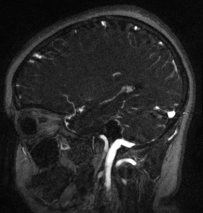 Normal brain MRI and venogram (Radiopaedia 39554-41862 Sagittal MRV 20).jpg