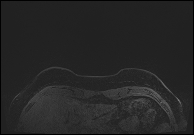 Normal breast MRI - dense breasts (Radiopaedia 80454-93850 C 4).jpg