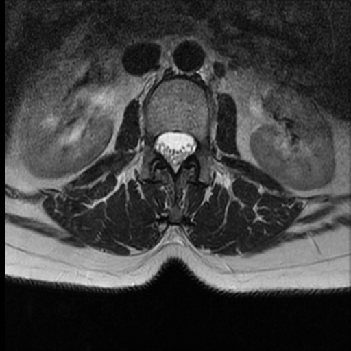 File:Normal cervical and thoracic spine MRI (Radiopaedia 35630-37156 H 1).png