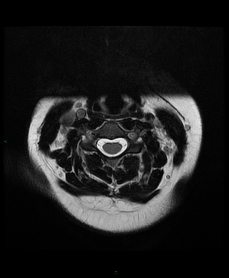 Normal cervical spine MRI (Radiopaedia 80146-93454 Axial T2 36).jpg
