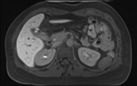 File:Normal hepatobiliary phase liver MRI (Radiopaedia 58968-66230 A 50).jpg