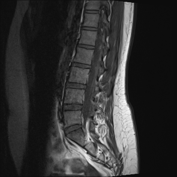 File:Normal lumbar spine MRI- 3 T (Radiopaedia 53280-59250 Sagittal T1 15).jpg