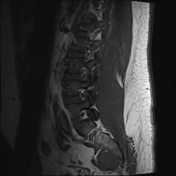 File:Normal lumbar spine MRI (Radiopaedia 47857-52609 Sagittal T1 16).jpg
