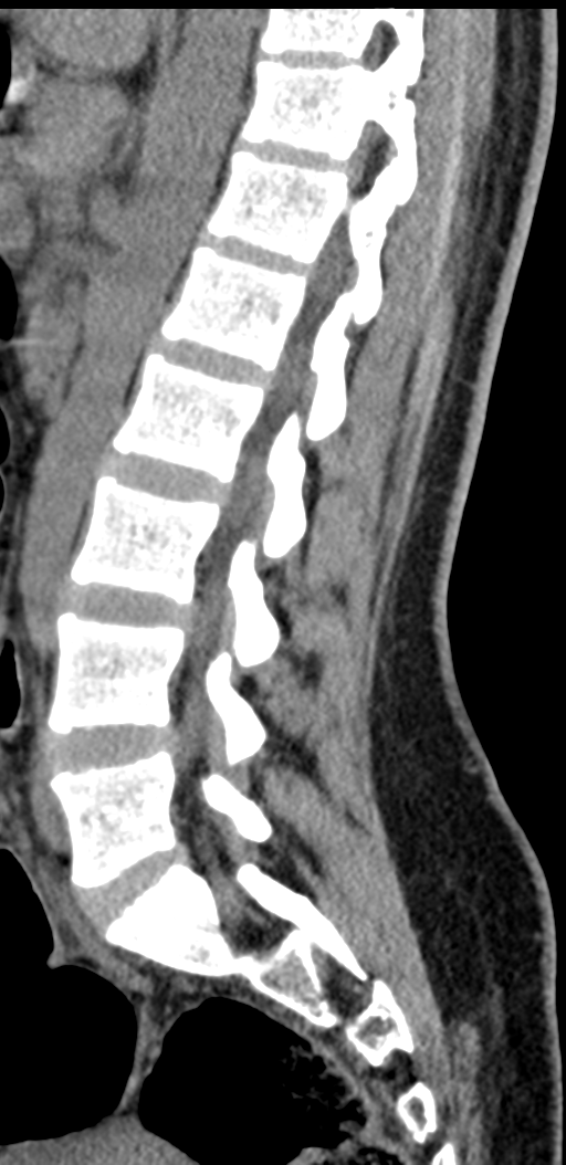 Normal lumbosacral CT (Radiopaedia 37923-39867 E 50).png