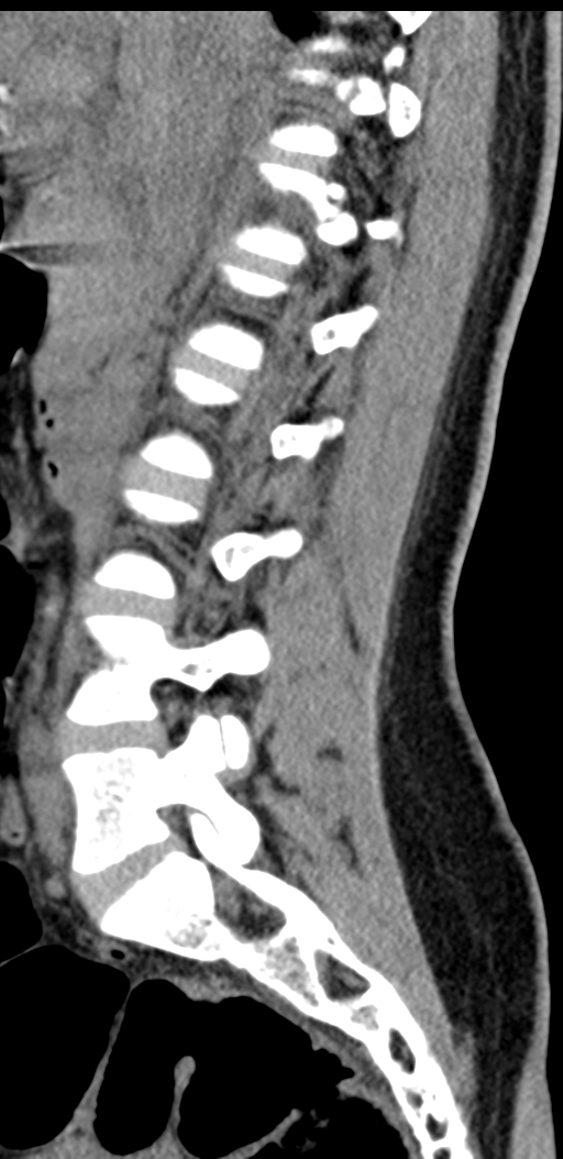 Normal lumbosacral CT (Radiopaedia 37923-39867 E 69).png