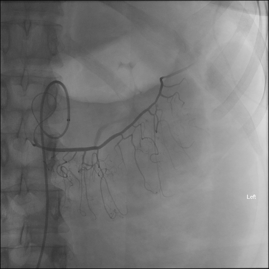 File:Normal middle colic artery angiogram (Radiopaedia 77417).jpg