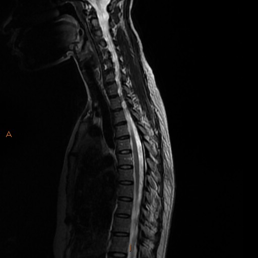 File:Normal spine MRI (Radiopaedia 77323-89408 E 6).jpg