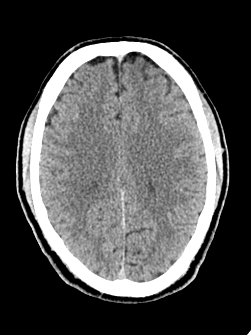 Normal trauma protocol brain and C-spine CT (Radiopaedia 83302-97709 Axial non-contrast 30).jpg