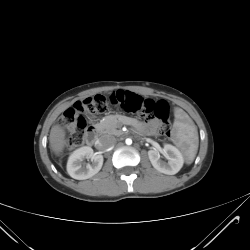 File:Nutmeg liver- Budd-Chiari syndrome (Radiopaedia 46234-50635 A 33).png