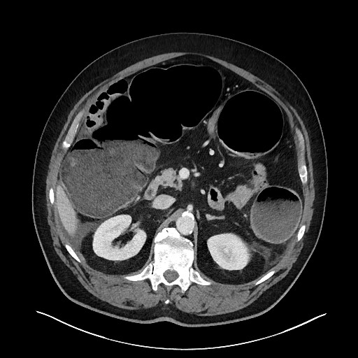 Obstructing sigmoid adenocarcinoma (Radiopaedia 58465-65619 A 57).jpg