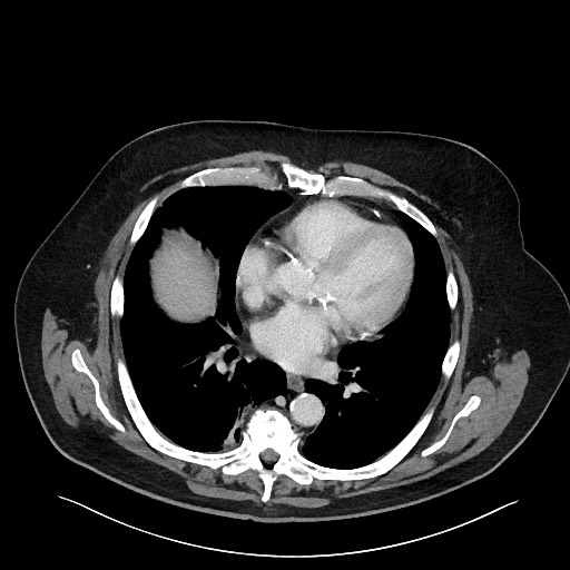 Obstructing sigmoid adenocarcinoma (Radiopaedia 58465-65619 A 7).jpg