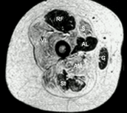 Transverse section from child with central core disease
