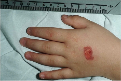 Inhaler-induced burn (Salbutomal)- injury could have been due to the physical effect of severe cooling of the skin (or mechanical abrasive effect of the aerosol blasts or chemical burn from the pharmaceutical/preservative/propellant aerosol or a combination of all)