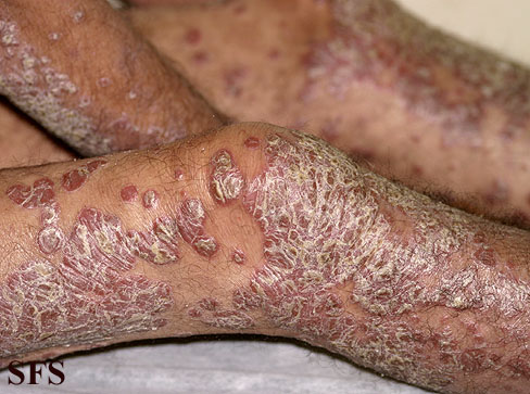 File:Psoriasis (Dermatology Atlas 29).jpg