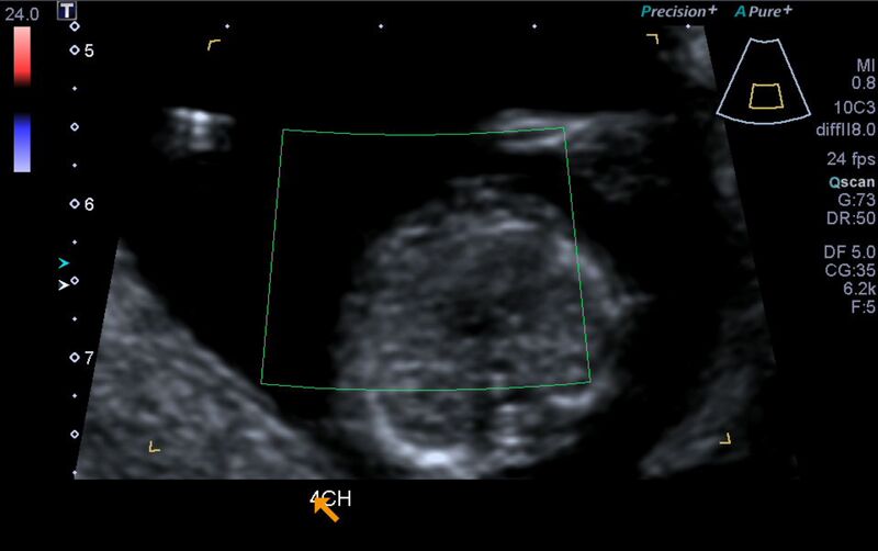 File:1st trimester nuchal-morphology ultrasound (Radiopaedia 44706-48477 Heart views cine with colour 88).jpg