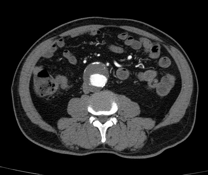 File:Abdominal aortic aneurysm (Radiopaedia 22421-22458 C+ arterial phase 50).jpg