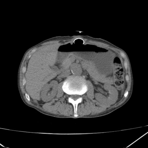 File:Abdominal aortic aneurysm (Radiopaedia 23703-23856 Axial non-contrast 20).jpg