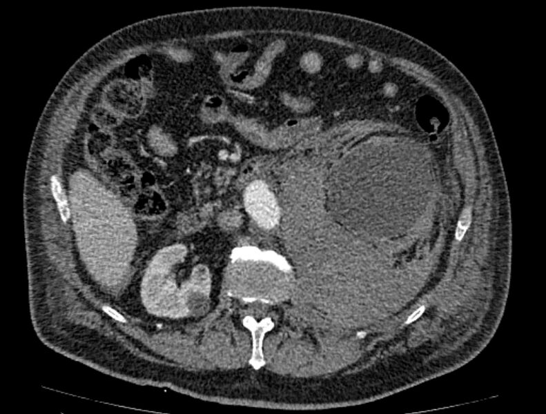 File:Abdominal aortic aneurysm rupture (Radiopaedia 54179-60362 Axial C+ portal venous phase 23).jpg
