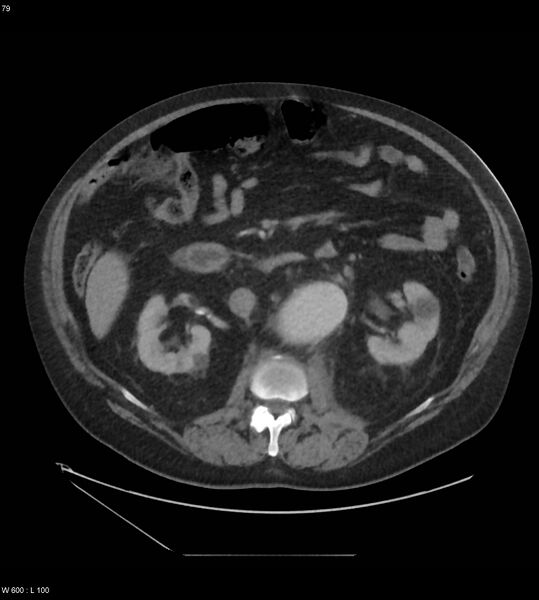 File:Abdominal aortic aneurysm with intramural hematoma then rupture (Radiopaedia 50278-55631 Axial C+ arterial phase 70).jpg