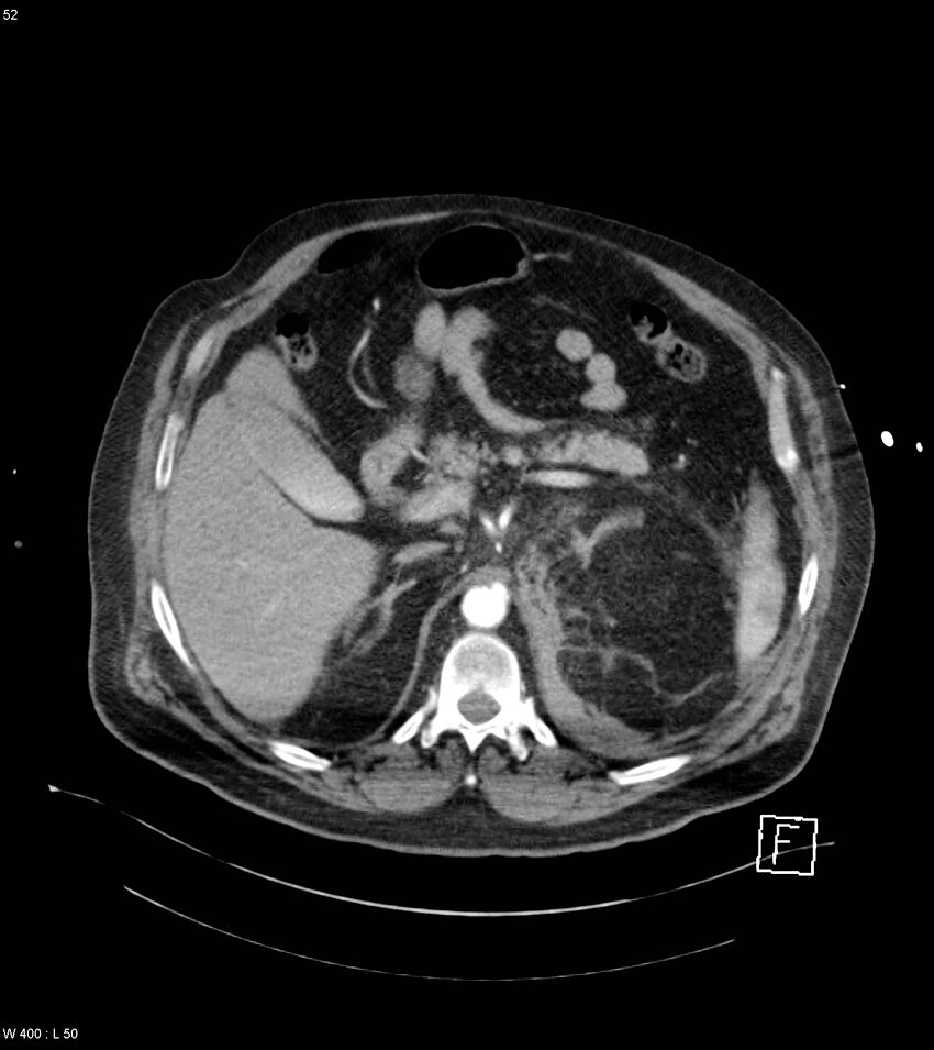 Abdominal aortic aneurysm with intramural hematoma then rupture (Radiopaedia 50278-55632 Axial C+ arterial phase 51).jpg
