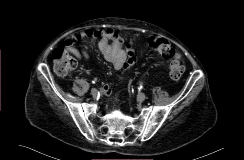Abdominal aortic interposition tube graft and aneurysm thrombosis (Radiopaedia 71438-81857 Axial C+ arterial phase 165).jpg