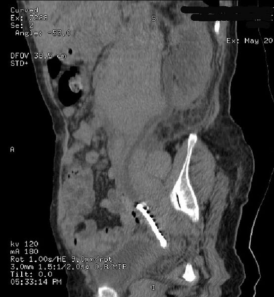 File:Abdominal lymphoma (Radiopaedia 23085-23115 Sagittal non-contrast 1).jpg