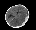 Abusive head trauma (Radiopaedia 70205-80252 Axial non-contrast 18).jpg