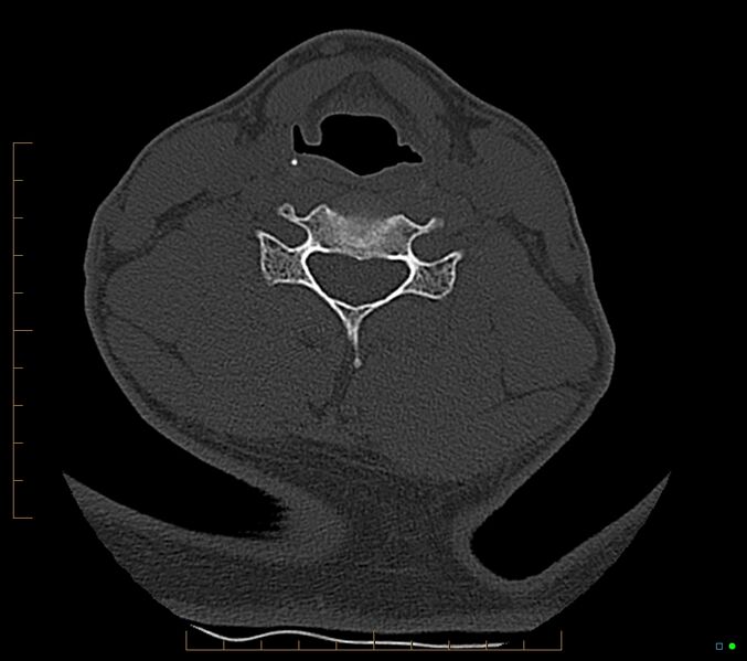 File:Accessory articulation of cervical transverse processes (Radiopaedia 82715-96933 Axial non-contrast 82).jpg