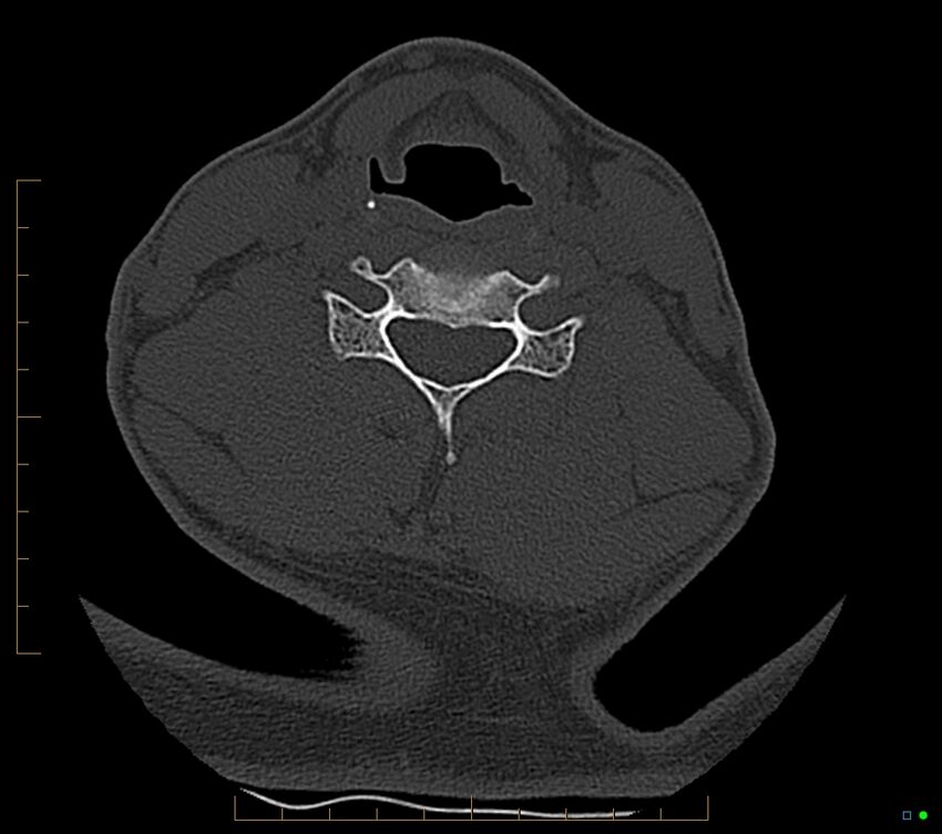 Accessory articulation of cervical transverse processes (Radiopaedia 82715-96933 Axial non-contrast 82).jpg