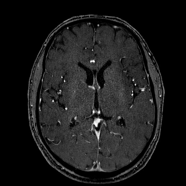 File:Accessory middle cerebral artery (Radiopaedia 73114-83828 Axial MRA 110).jpg