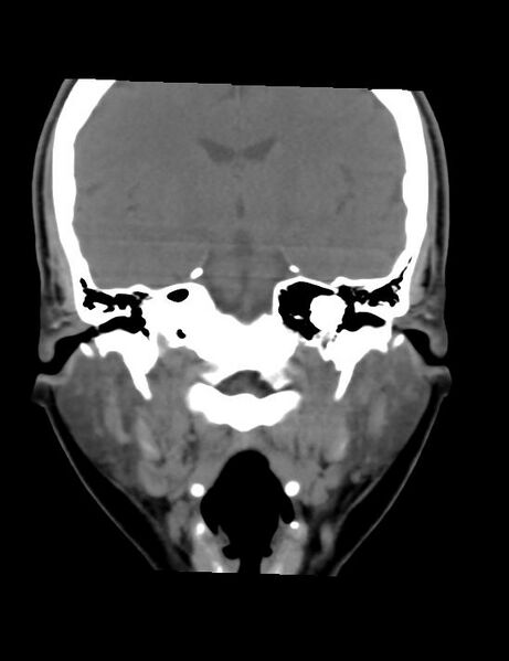 File:Accessory parotid glands (Radiopaedia 27289-27472 Coronal non-contrast 6).jpg