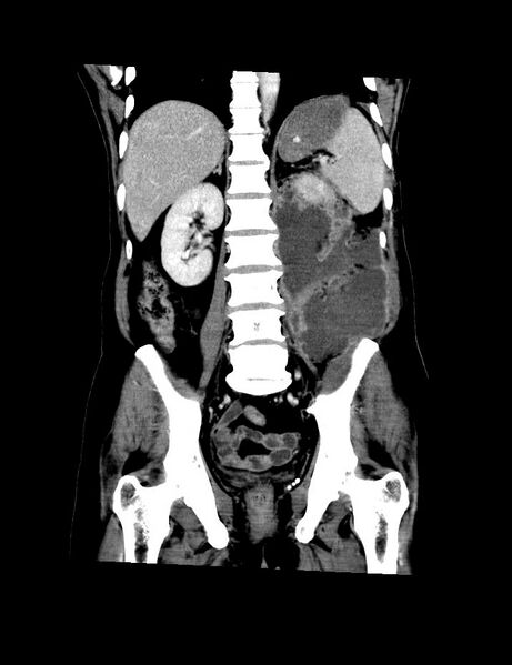 File:Accessory right inferior hepatic vein (Radiopaedia 33050-34067 Coronal C+ portal venous phase 9).jpg