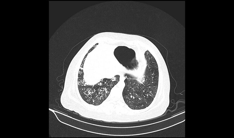 File:Acquired tracheo-esophageal fistula (Radiopaedia 51356-57103 Axial lung window 34).jpg