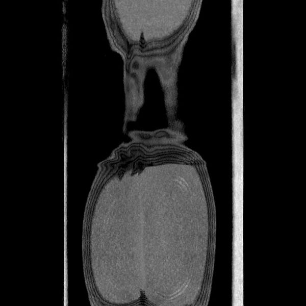 File:Active colonic bleed on CT (Radiopaedia 49765-55025 Coronal art MIP 63).jpg