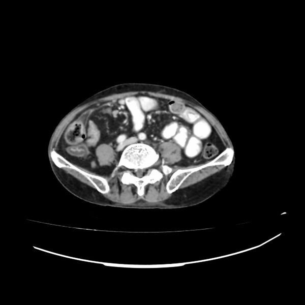File:Acute-on-chronic Crohn disease with enteroenteric fistula (Radiopaedia 66686-75987 B 27).jpg