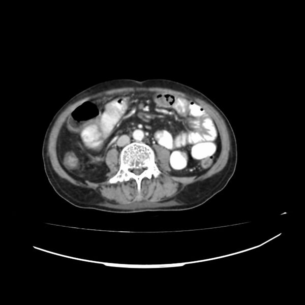 File:Acute-on-chronic Crohn disease with enteroenteric fistula (Radiopaedia 66686-75987 B 8).jpg
